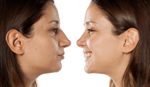 Rhinoplasty Cost